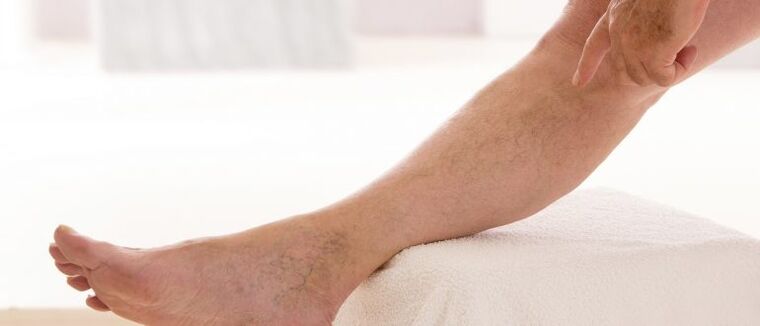 Varikózis erek a lábakon